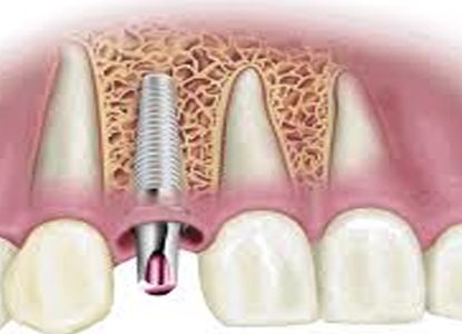 Dental implant – a modern technique to solve people’s tooth problem