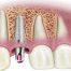 Dental implant – a modern technique to solve people’s tooth problem