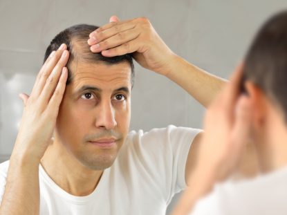Clinics in Singapore with the Best Hair Loss Treatment