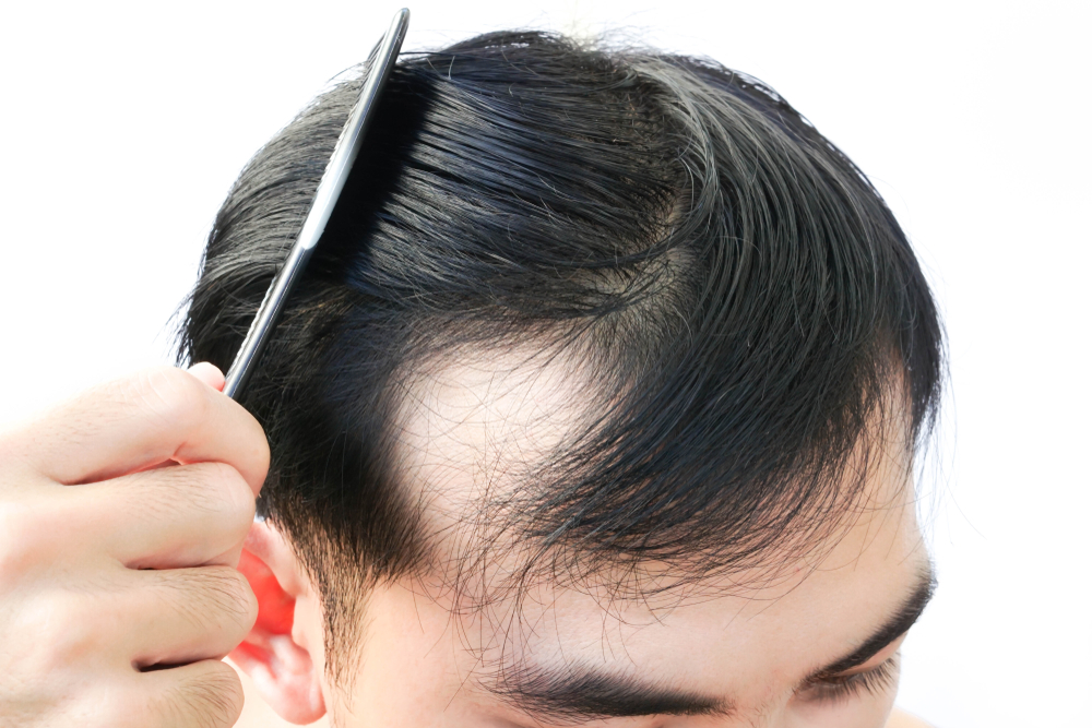 Book an appointment for hair loss treatment in Singapore today.